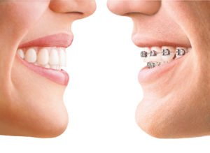 Precio ortodoncia lingual