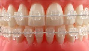 imagen muestra brackets estéticos