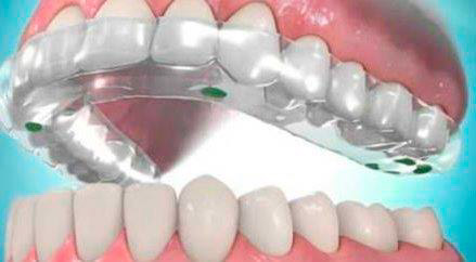 imagen de placa para bruxismo