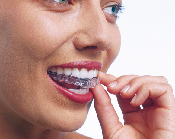 imagen muestra ortodoncia invisible con invisalign