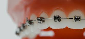 imagen que muestra precio de los frenillos