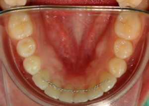 imagen muestra un retenedor fijo de ortodoncia